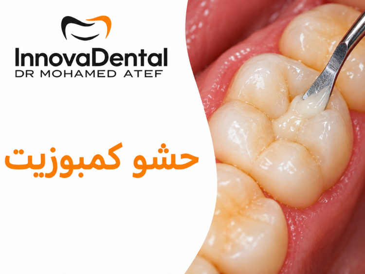 سعر حشو كمبوزيت التجميلي في مصر | المميزات والعيوب